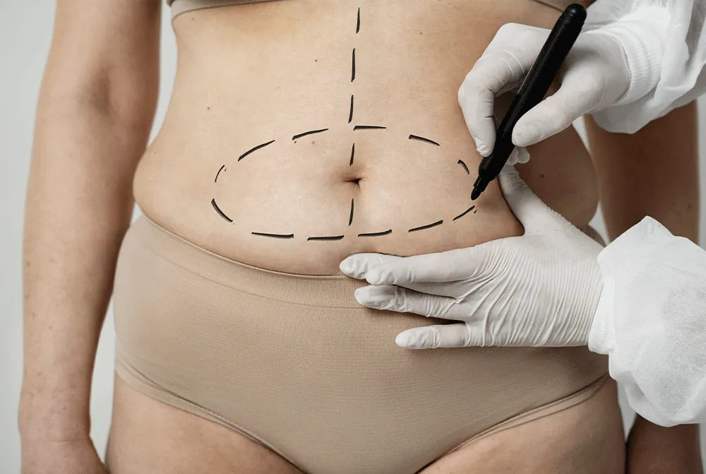 What is abdominoplasty?