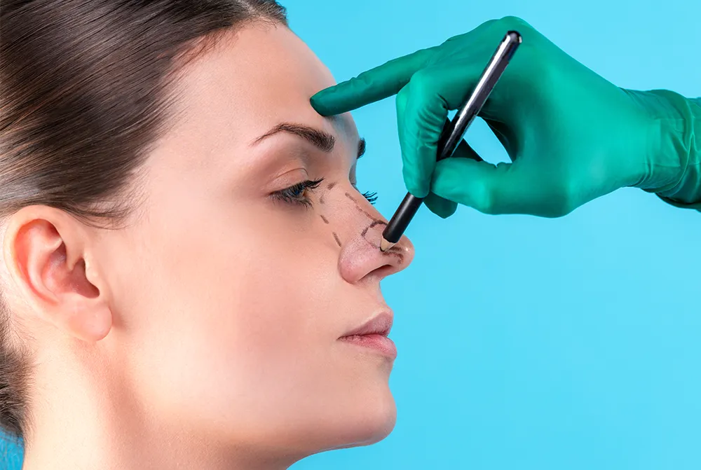 Rhinoplasty