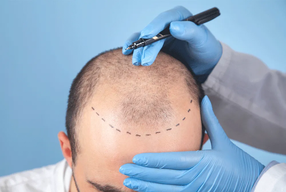 Hair Transplant
